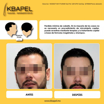 Slider image (3) Kbapel Hair Transplant